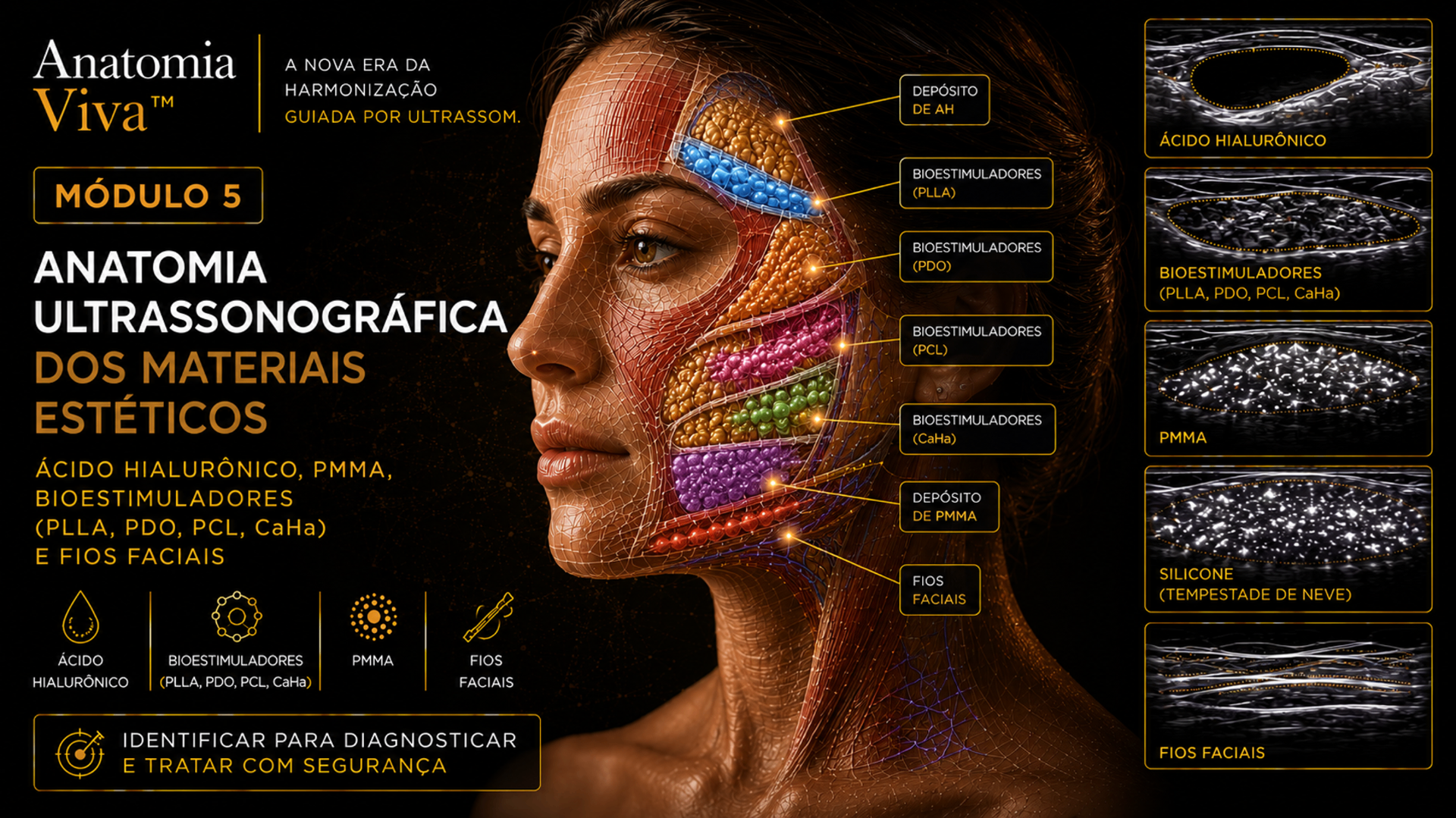 Módulo 5 — Materiais Estéticos no Ultrassom: imagem ultrassonográfica com preenchedor de ácido hialurônico, bioestimulador (CaHA), PMMA e fios (eco linear) identificados.