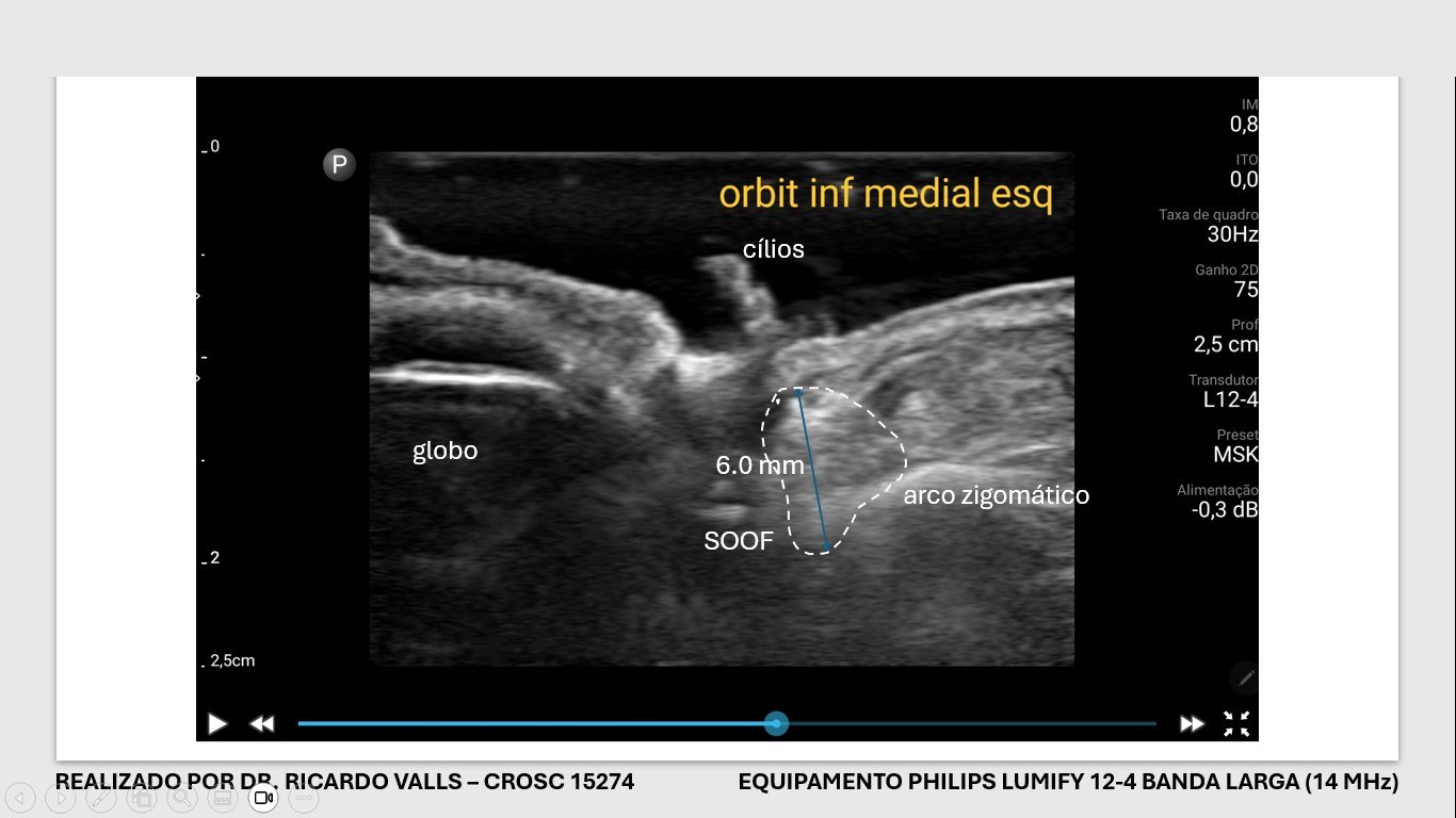 Pré-cirúrgico blefaroplastia (SOOF)